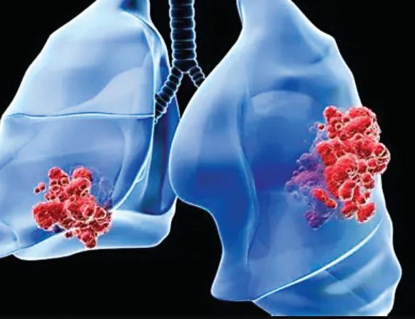 Intas Pharma unveils India's first novel immunotherapy for advanced small cell lung cancer